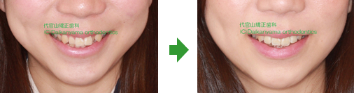 口元の様子:裏側矯正