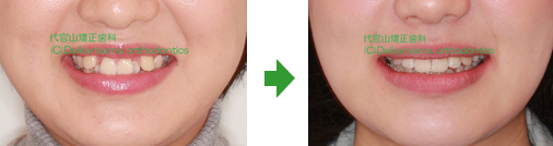 口元の様子:舌側矯正