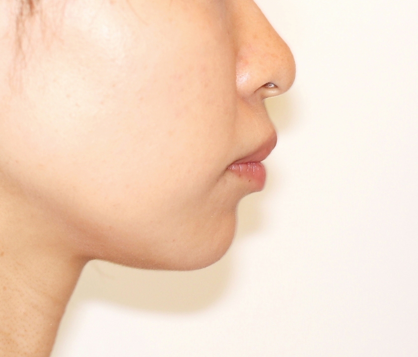 結婚式を控えた矯正治療日記