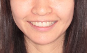 結婚式を控えた矯正治療日記